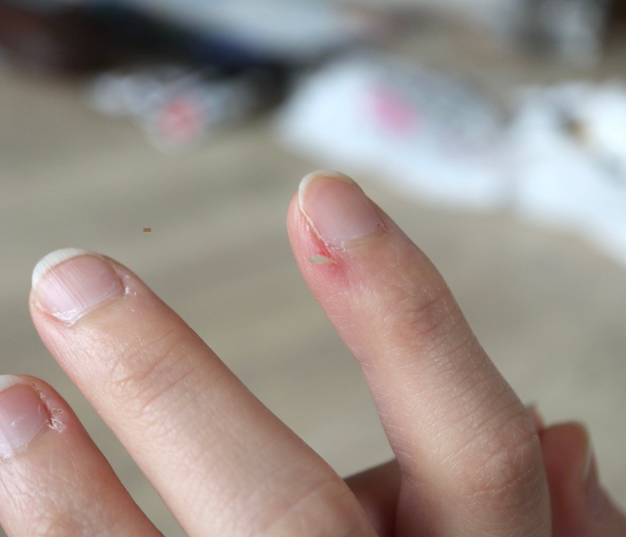 hangnails